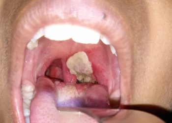 What is the disease diphtheria? Learn about the illness that killed five people in Odisha, India.