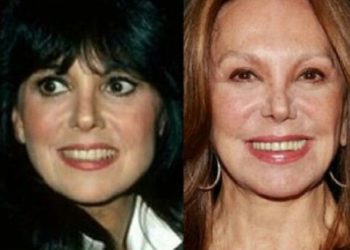 Marlo Thomas’s makeover with plastic surgery: before and after