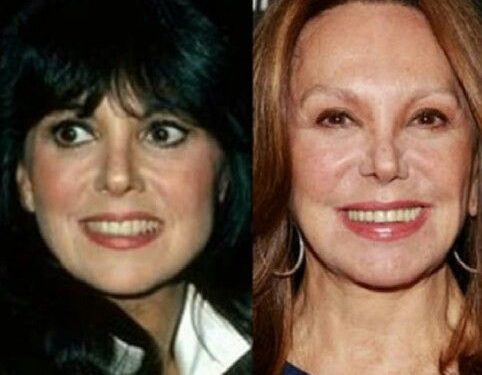 Marlo Thomas’s makeover with plastic surgery: before and after