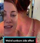 Why should you avoid attempting the newest trend that TikTokers are “sunburning” their acne