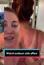 Why should you avoid attempting the newest trend that TikTokers are “sunburning” their acne
