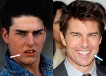 Has Tom Cruise undergone cosmetic procedures to keep his “youthful look”?