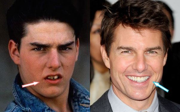 Has Tom Cruise undergone cosmetic procedures to keep his “youthful look”?